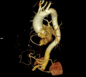 CAZ nr 129: Schwannom nerv vag