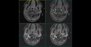CAZ nr 96: Boala Barlow – prolaps de valvă mitrală cu disjuncţie de inel mitral si fenomen de curbare posterioară.