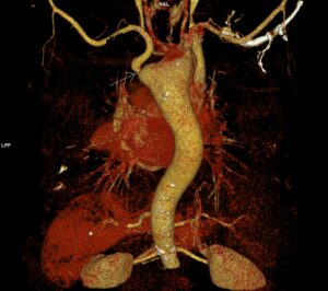 CAZ nr 96: Boala Barlow – prolaps de valvă mitrală cu disjuncţie de inel mitral si fenomen de curbare posterioară.