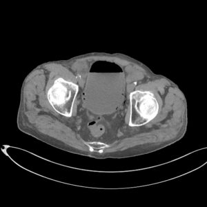 CAZ nr 96: Boala Barlow – prolaps de valvă mitrală cu disjuncţie de inel mitral si fenomen de curbare posterioară.