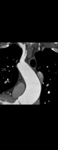 CAZ nr 38 Scor de calciu zero la examinarea CT cardiacă – înseamnă că pacientul nu are stenoze coronariene semnificative?!