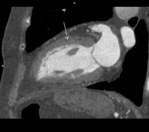CAZ nr 38 Scor de calciu zero la examinarea CT cardiacă – înseamnă că pacientul nu are stenoze coronariene semnificative?!