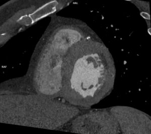 CAZ nr 21 embolie pulmonară / trombembolism pulmonar