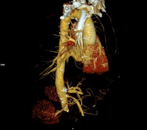 CAZ nr 62: Paralizie de diafragm – cu mulţumiri Dr Veronica Marcu