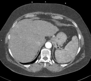 CAZ nr 38 Scor de calciu zero la examinarea CT cardiacă – înseamnă că pacientul nu are stenoze coronariene semnificative?!