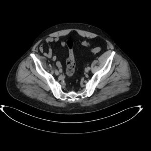 CAZ nr 119: Imagistica CT și IRM la un pacient cu tumoră stromală gastro-intestinală  (GIST)