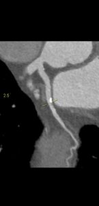 CAZ nr 62: Paralizie de diafragm – cu mulţumiri Dr Veronica Marcu